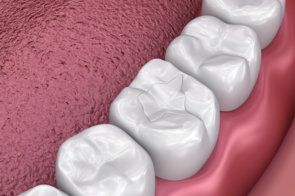 Understanding A Silver Versus Tooth Colored Dental Filling