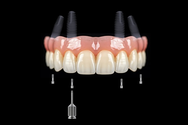 Overdentures Supported By Dental Implants