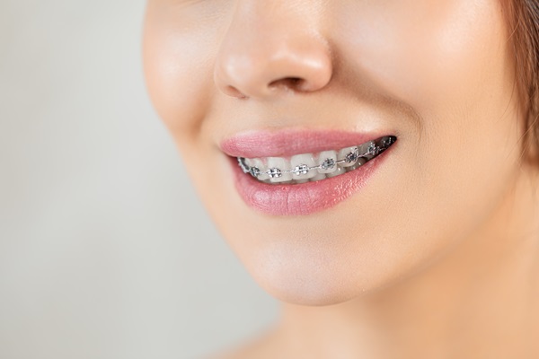 Braces As Part Of A Smile Makeover